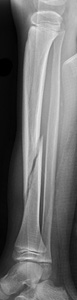 Figure 3_1392701 displaced tibia fracture_lat_new